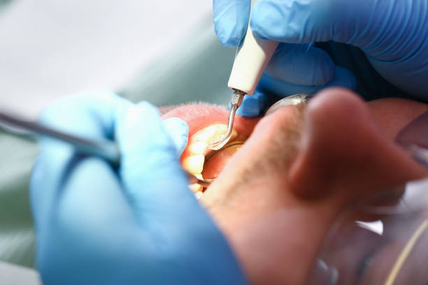 Best Emergency Dental Extractions in Yardley, PA